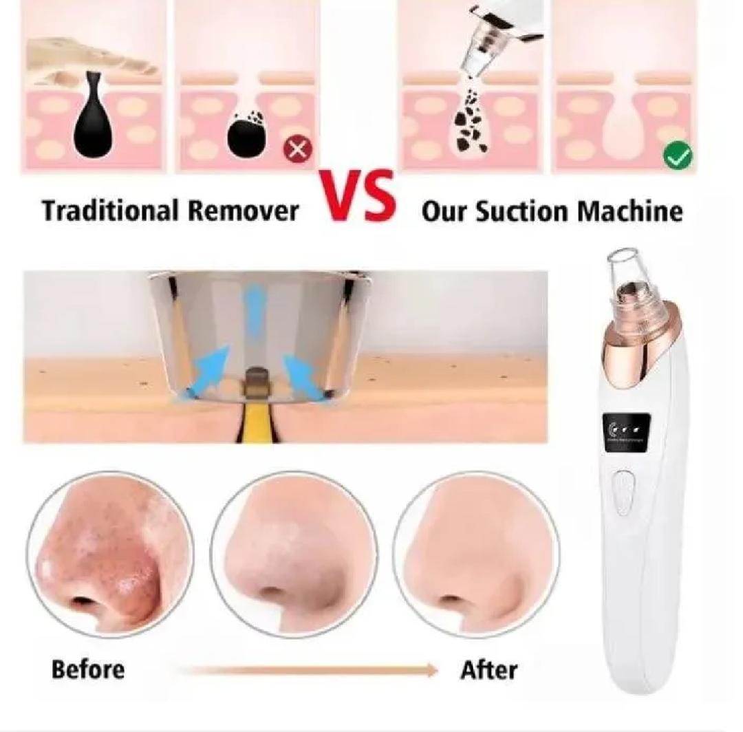 Upgraded Blackhead Remover Vacuum Facial Pore Cleaner Electric Acne Comedone Whitehead Extractor Tool 5 Probes For Women And Men